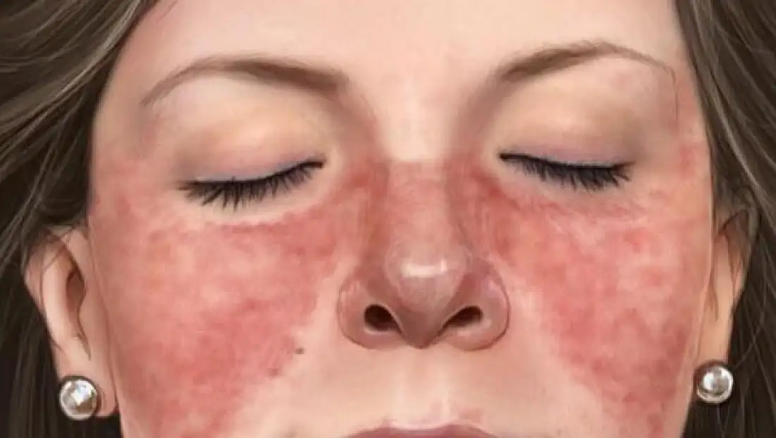 Kadınlarda Lupus riski erkeklerden 9 kat daha fazla