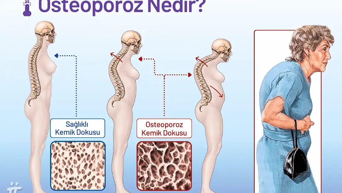 Kemik erimesine ne iyi gelir?