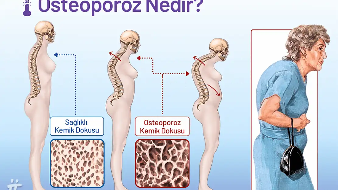 Kemik erimesine ne iyi gelir?