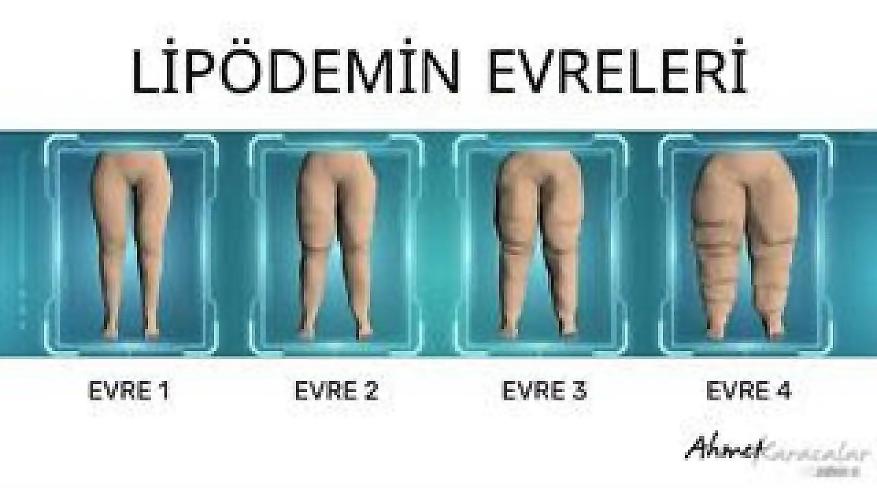 Prof. Dr. Ahmet Karacalar'dan Lipödem açıklaması: 'Mucize bir ilaç yok'