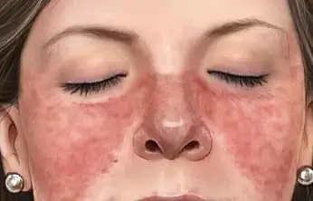 Kadınlarda Lupus riski erkeklerden 9 kat daha fazla