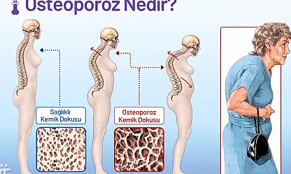 Kemik erimesine ne iyi gelir?