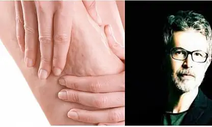 Lipödem hastalarında varis tedavisi nasıl planlanmalı? Uzmanlardan kritik uyarılar