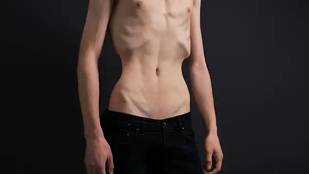 Anoreksiya Nervoza Sessizce İlerliyor