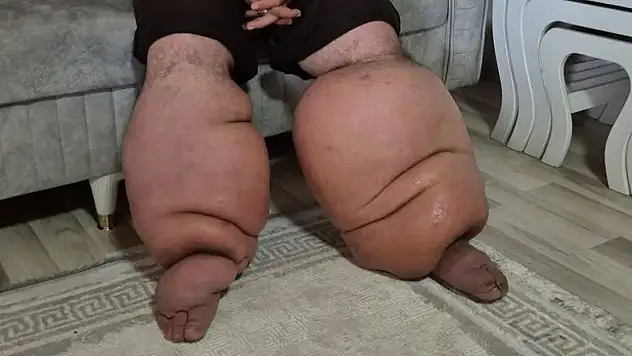 'Fil Hastalığı' teşhisi konulan Seyfettin Taşcı artık yürüyemiyor