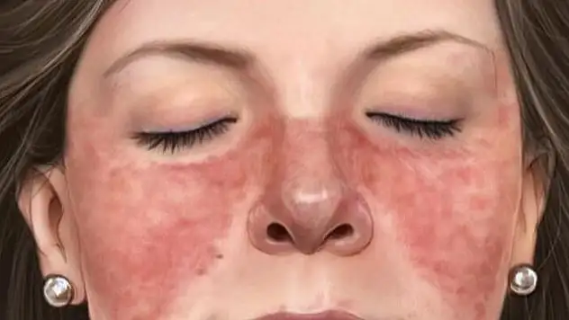 Kadınlarda Lupus riski erkeklerden 9 kat daha fazla