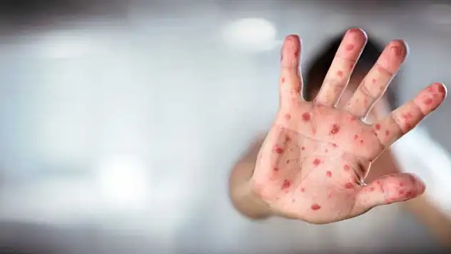Kızamık Vakaları Yeniden Yükselişte Uzmanlardan Aşı Uyarısı