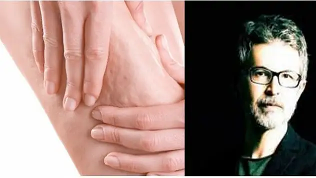 Lipödem hastalarında varis tedavisi nasıl planlanmalı? Uzmanlardan kritik uyarılar