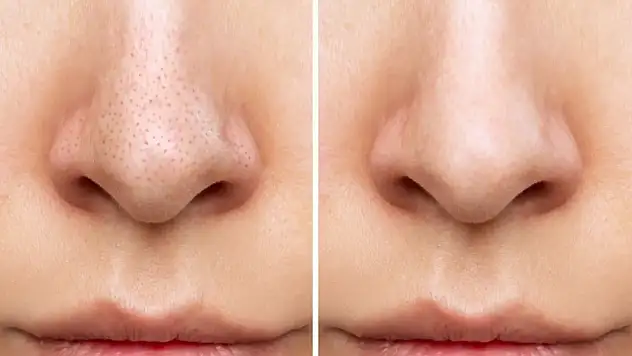 Siyah noktalardan kurtulmak mümkün mü? İşte cildi arındıran 7 etkili yöntem