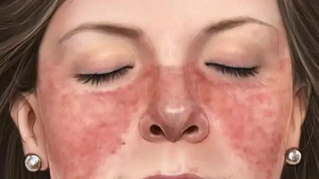 Kadınlarda Lupus riski erkeklerden 9 kat daha fazla