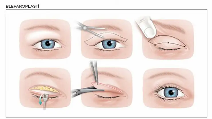 Göz kapağı ameliyatı tercih listesinde