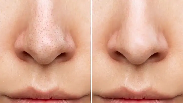 Siyah noktalardan kurtulmak mümkün mü? İşte cildi arındıran 7 etkili yöntem