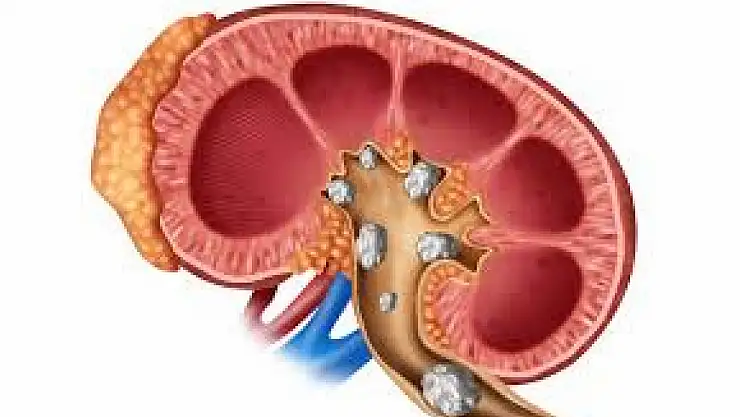 Uzmandan böbrek taşı uyarısı