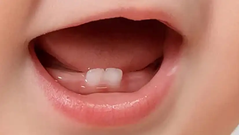 Bebeklerde ilk dişler: Sağlıklı gelişim için erken önlem şart