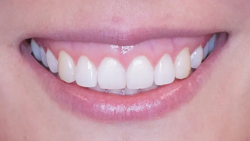 Duruş bozukluklarının altında diş sıkma yatıyor olabilir! işte 5 etkili çözüm önerisi