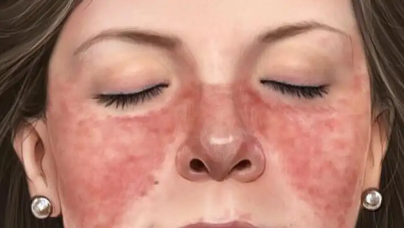 Kadınlarda Lupus riski erkeklerden 9 kat daha fazla