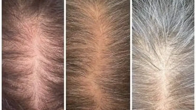 Kadınlarda saç dökülmesine dikkat