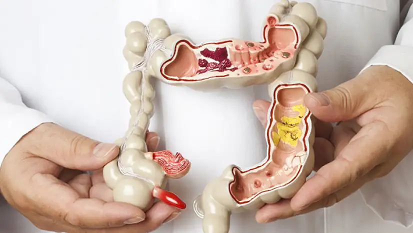 Kolon kanseri genç yaşta artıyor: Uzmanlardan sağlıksız beslenme uyarısı