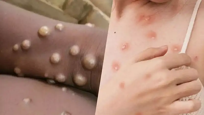 Sinsi virüs alarmı: Vaka sayısı 300'ü aştı, ilk ölüm kayıtlara geçti