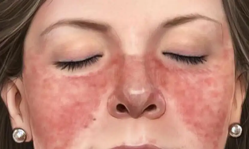 Kadınlarda Lupus riski erkeklerden 9 kat daha fazla